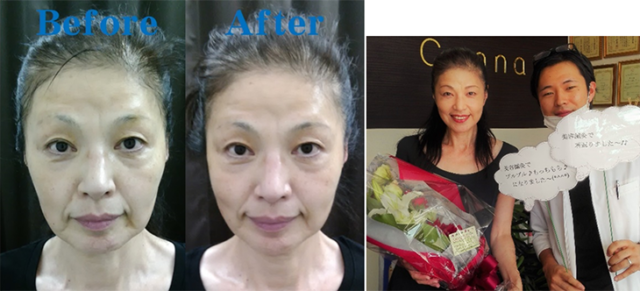 美容鍼灸ご感想 60代 女性 熊本熊本市 Y・O様 福岡市の美容鍼サロンCannaカンナ