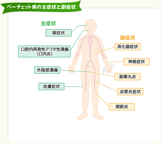 カンナベーチェット病治療